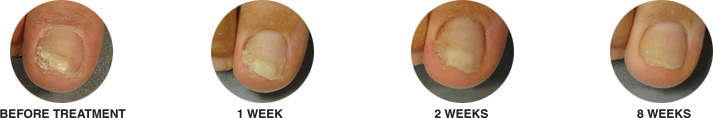 Before and after Nalox treatment